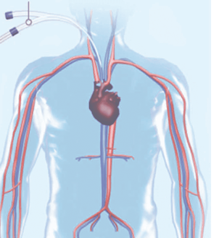 Thrombose Veineuse Profonde La Phase Aigu Quel Dispositif