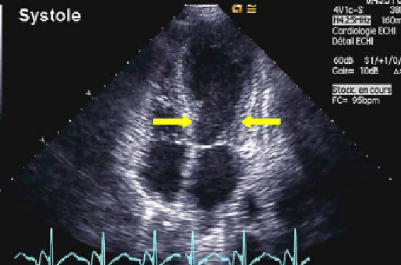 Quel bilan hémodynamique non invasif en urgence en USIC ? Cardiologie